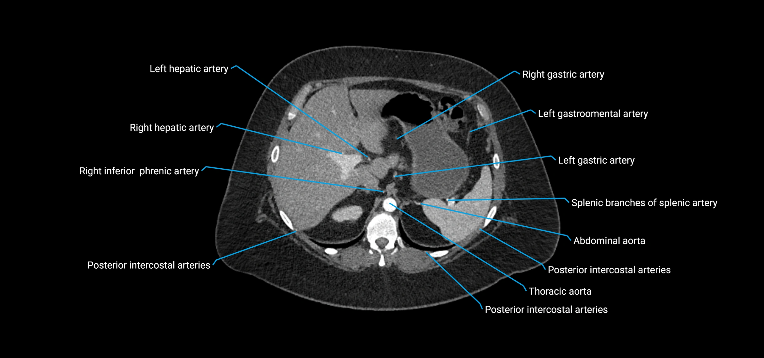 CTA abdomen axial cross sectional anatomy labelled image_42 (2).webp